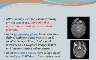  MRI is mainly used for lesions involving
critical organs (i.e., infraorbital or
intracranial extension) or treatment
planning.
 In the proliferative phase, lesions are well-
defined with low signal intensity on T1-
weighted image (T1WI), high signal
intensity on T2-weighted image (T2WI),
and intense contrast enhancement.
 In the involuting phase, there is high signal
intensity on T1WI due to fatty replacement.
 