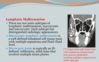 Lymphatic Malformation
There are two main subtypes of
lymphatic malformation, macrocystic
and microcystic. Each subtype has
distinguished radiologic appearances.
Macrocystic lymphatic malformation is
a well-defined lobulated soft tissue mass
with multiple septations and fluid–fluid
level.
Microcystic lesion is typically an ill-
defined, infiltrative, solid mass that
involves multiple tissue planes
CT images show soft tissue mass
with serpiginous enhancement
and numerus phleboliths
involving multiple compartments
of the right face
 