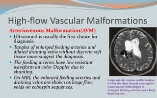 High-flow Vascular Malformations
Arteriovenous Malformation(AVM)
 Ultrasound is usually the first choice for
diagnosis.
 Tangles of enlarged feeding arteries and
dilated draining veins without discrete soft
tissue mass suggest the diagnosis.
 The feeding arteries have low resistant
waveform on color Doppler due to
shunting.
 On MRI, the enlarged feeding arteries and
draining veins are shown as large flow
voids on echospin sequences.
Large arterial venous malformation
within the right frontal parasagittal
white matter with tangles of
enlarged feeding arteries and a large
draining vein
 