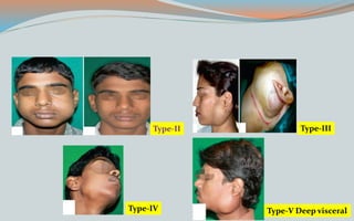 Type-II Type-III
Type-IV Type-V Deep visceral
 