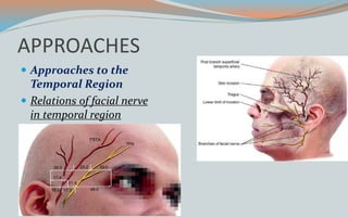 APPROACHES
 Approaches to the
Temporal Region
 Relations of facial nerve
in temporal region
 