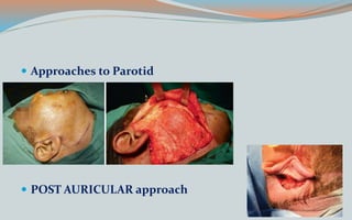  Approaches to Parotid
 POST AURICULAR approach
 