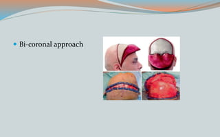  Bi-coronal approach
 