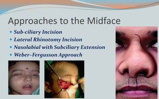 Approaches to the Midface
 Sub-ciliary Incision
 Lateral Rhinotomy Incision
 Nasolabial with Subciliary Extension
 Weber–Fergusson Approach
 