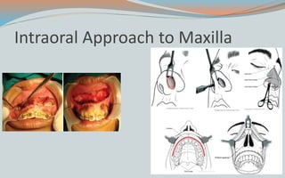 Intraoral Approach to Maxilla
 