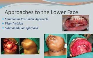 Approaches to the Lower Face
 Mandibular Vestibular Approach
 Visor Incision
 Submandibular approach
 
