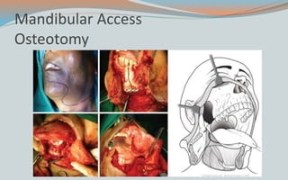 Mandibular Access
Osteotomy
 