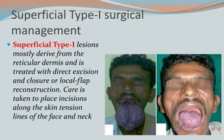 Superficial Type-I surgical
management
 Superficial Type-I lesions
mostly derive from the
reticular dermis and is
treated with direct excision
and closure or local-flap
reconstruction. Care is
taken to place incisions
along the skin tension
lines of the face and neck
 