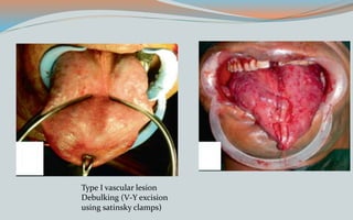 Type I vascular lesion
Debulking (V-Y excision
using satinsky clamps)
 