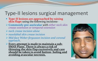 Type-II lesions surgical management
 Type-II lesions are approached by raising
skin flaps using the following incisions-
 Commonly-pre-auricular with either neck skin
crease extension or temporal extension
 neck crease incision alone
 nasolabial skin crease incision
 Mid-face Weber-fergusson incision and coronal
approach.
 Every attempt is made to maintain a sub-
SMAS Plane. There is always a risk of
thinning the skin flap excessively and care
should be taken to avoid button- holing and
avoiding avascular necrosis.
 
