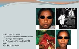 Type II vascular lesion
(a) Preoperative venous malformation
of Right buccal space
(b) Post contrast T2 weighted MRI
image
(c) Excision of lesion
 