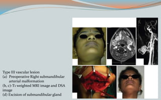 Type III vascular lesion
(a) Preoperative Right submandibular
arterial malformation
(b, c)-T1 weighted MRI image and DSA
image
(d) Excision of submandibular gland
 