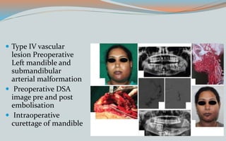  Type IV vascular
lesion Preoperative
Left mandible and
submandibular
arterial malformation
 Preoperative DSA
image pre and post
embolisation
 Intraoperative
curettage of mandible
 