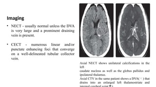 VASCULAR MALFORMATION OF BRAIN RADIOLOGY.pptx