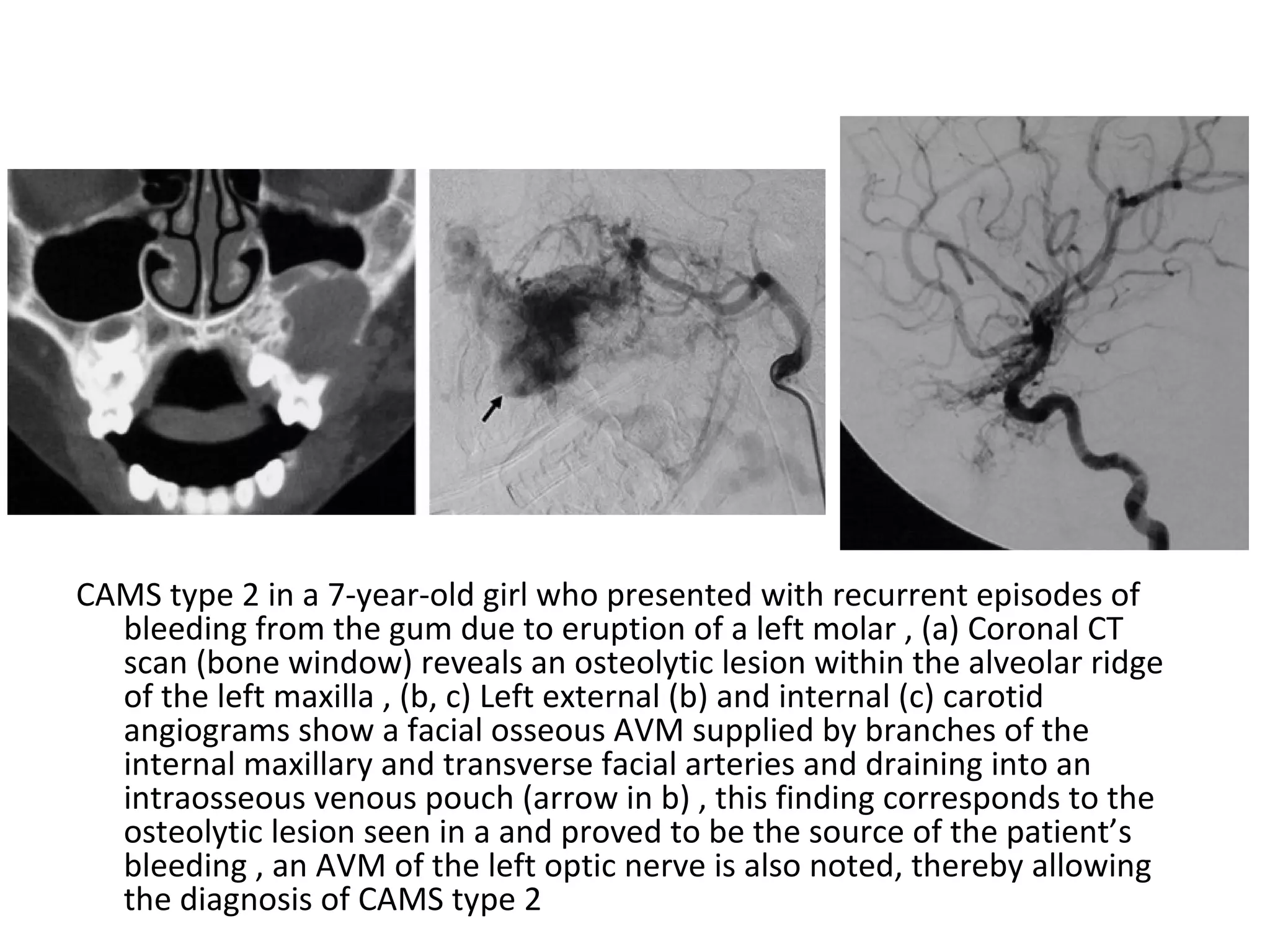 Diagnostic Imaging of Intracranial Vascular malformations | PPT