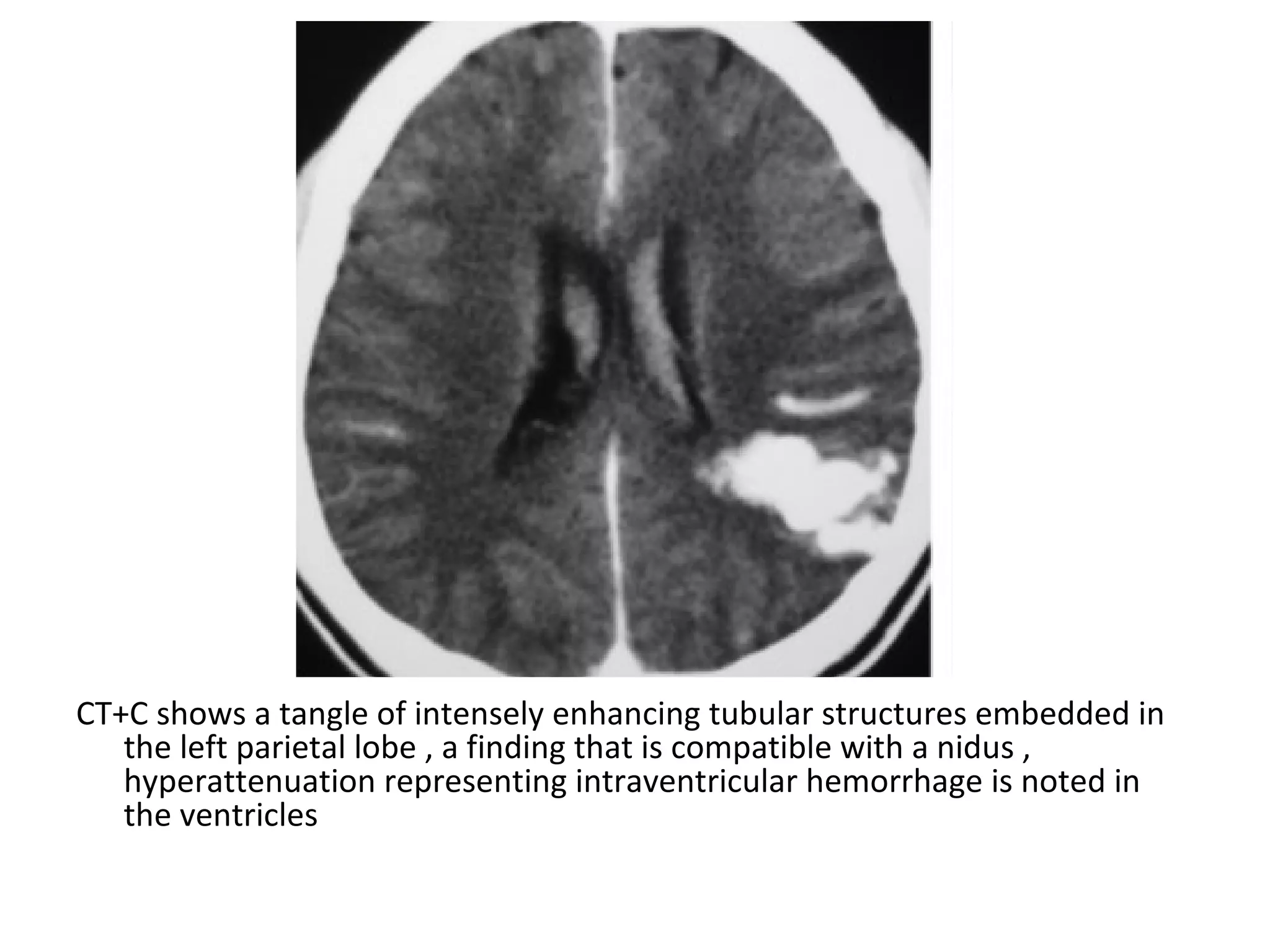 Diagnostic Imaging of Intracranial Vascular malformations | PPT