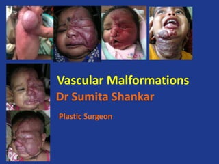 Vascular Malformations
Dr Sumita Shankar
Plastic Surgeon
 