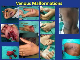 Vascular Anomalies: Vascular Tumours and Vascular malformations