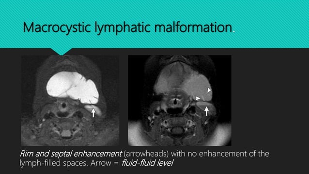 Vascular malformations of the head and neck | PPTX | Blood Disorders ...