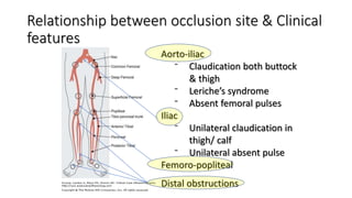 Relationship between occlusion site & Clinical
features
Aorto-iliac
⁻ Claudication both buttock
& thigh
⁻ Leriche’s syndrome
⁻ Absent femoral pulses
Iliac
⁻ Unilateral claudication in
thigh/ calf
⁻ Unilateral absent pulse
Femoro-popliteal
Distal obstructions
 