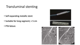 Transluminal stenting
• Self expanding metallic stent
• Suitable for long segment; > 5 cm
• PTA failure
 
