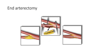 End arterectomy
 