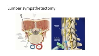 Lumber sympathetectomy
 