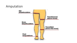 Amputation
 