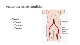 Acute occlusive condition
• Causes
• Emboli
• Thrombi
• Trauma
 