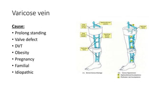 Varicose vein
Cause:
• Prolong standing
• Valve defect
• DVT
• Obesity
• Pregnancy
• Familial
• Idiopathic
 