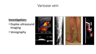 Varicose vein
Investigation:
• Duplex ultrasound
imaging
• Venography
 