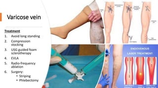 Varicose vein
Treatment
1. Avoid long standing
2. Compression
stocking
3. USG guided foam
sclerotherapy
4. EVLA
5. Radio-frequency
ablation
6. Surgery:
• Striping
• Phlebectomy
 