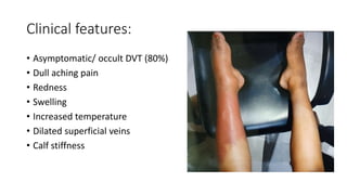 Clinical features:
• Asymptomatic/ occult DVT (80%)
• Dull aching pain
• Redness
• Swelling
• Increased temperature
• Dilated superficial veins
• Calf stiffness
 