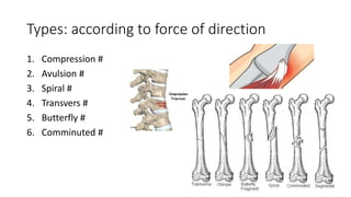 Types: according to force of direction
1. Compression #
2. Avulsion #
3. Spiral #
4. Transvers #
5. Butterfly #
6. Comminuted #
 