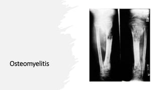 Osteomyelitis
 
