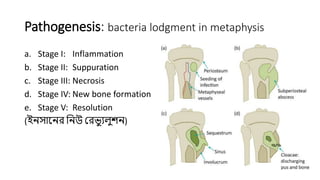 Pathogenesis: bacteria lodgment in metaphysis
a. Stage I: Inflammation
b. Stage II: Suppuration
c. Stage III: Necrosis
d. Stage IV: New bone formation
e. Stage V: Resolution
(ইনসাননর ননউ ররভ্য ুলুশন)
 