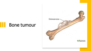 Bone tumour
 