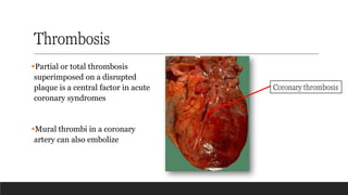 Thrombosis
▪Partial or total thrombosis
superimposed on a disrupted
plaque is a central factor in acute
coronary syndromes
▪Mural thrombi in a coronary
artery can also embolize
Coronary thrombosis
 