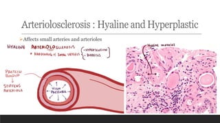 Arteriolosclerosis : Hyaline and Hyperplastic
➢Affects small arteries and arterioles
 
