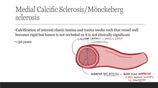 Medial Calcific Sclerosis/Mönckeberg
sclerosis
▪Calcification of internal elastic lamina and tunica media such that vessel wall
becomes rigid but lumen is not occluded so it is not clinically significant
▪>50 years
 