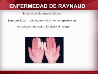 ENFERMEDAD DE RAYNAUD
Esta crisis evoluciona en 3 fases:
Síncope local: palidez, provocado por los espasmos en
los capilares que dejan a los dedos sin sangre

 