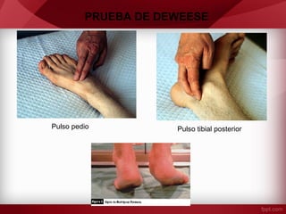 PRUEBA DE DEWEESE

Pulso pedio

Pulso tibial posterior

 