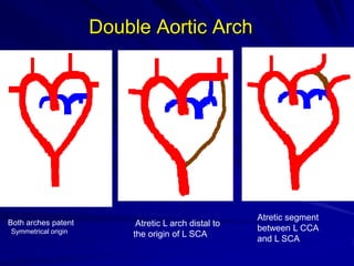 Double Aortic Arch

Both arches patent
Symmetrical origin

Atretic L arch distal to
the origin of L SCA

Atretic segment
between L CCA
and L SCA

 