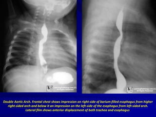 Double Aortic Arch. Frontal chest shows impression on right-side of barium-filled esophagus from higher
right-sided arch and below it an impression on the left-side of the esophagus from left-sided arch.
Lateral film shows anterior displacement of both trachea and esophagus.

 