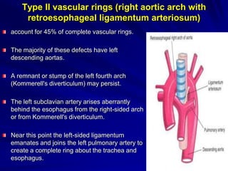Type II vascular rings (right aortic arch with
retroesophageal ligamentum arteriosum)
account for 45% of complete vascular rings.
The majority of these defects have left
descending aortas.
A remnant or stump of the left fourth arch
(Kommerell's diverticulum) may persist.
The left subclavian artery arises aberrantly
behind the esophagus from the right-sided arch
or from Kommerell's diverticulum.
Near this point the left-sided ligamentum
emanates and joins the left pulmonary artery to
create a complete ring about the trachea and
esophagus.
40

 