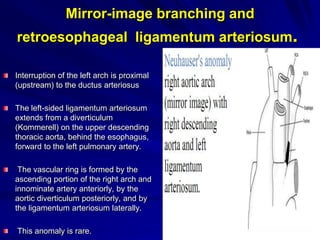 Mirror-image branching and

retroesophageal ligamentum arteriosum.
Interruption of the left arch is proximal
(upstream) to the ductus arteriosus
The left-sided ligamentum arteriosum
extends from a diverticulum
(Kommerell) on the upper descending
thoracic aorta, behind the esophagus,
forward to the left pulmonary artery.
The vascular ring is formed by the
ascending portion of the right arch and
innominate artery anteriorly, by the
aortic diverticulum posteriorly, and by
the ligamentum arteriosum laterally.
This anomaly is rare.

 
