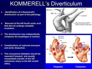 KOMMERELL’s Diverticulum
identification of a Kommerell's
diverticulum as part of the pathology.

Remnant of the left fourth aortic arch
that did not undergo complete
involution.
The diverticulum may independently
compress the esophagus or trachea.

Complications of ruptured aneurysm
and aortic dissection.
This aneurysmal dilatation should be
resected if present and usually
necessitates transfer of the left
subclavian artery to the left carotid
artery

 