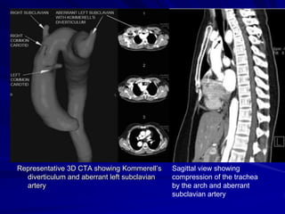 Representative 3D CTA showing Kommerell’s
diverticulum and aberrant left subclavian
artery

Sagittal view showing
compression of the trachea
by the arch and aberrant
subclavian artery

 