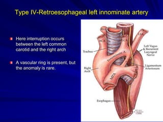 Type IV-Retroesophageal left innominate artery

Here interruption occurs
between the left common
carotid and the right arch
A vascular ring is present, but
the anomaly is rare.

 
