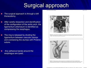 Surgical approach
The surgical approach is through a left
thoracotomy.
After careful dissection and identification
of the configuration of the aortic arch, the
ligamentum arteriosum is identified as
compressing the esophagus.
The ring is released by dividing the
ligamentum between vascular clamps
and oversewing the stumps with Prolene
suture.

Any adhesive bands around the
esophagus are lysed.

 